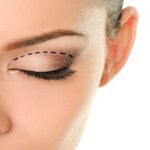 Göz Kapağı Kaldırma