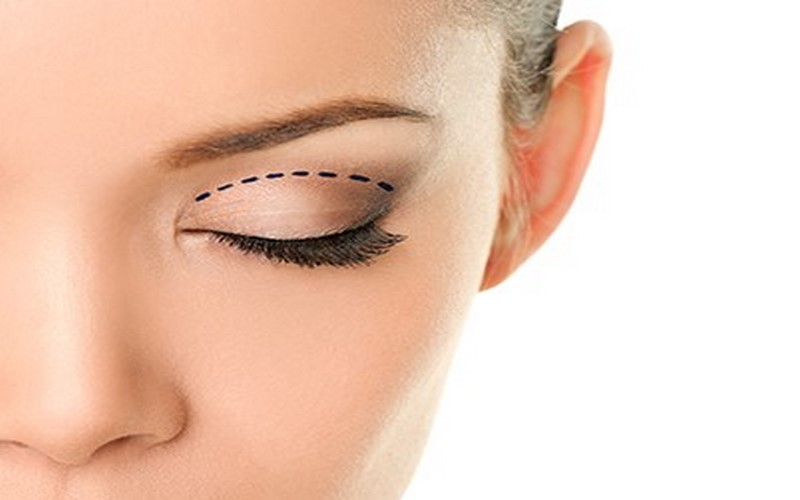 Göz Kapağı Kaldırma