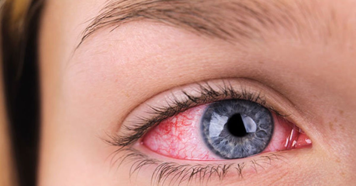 Göz Tansiyonu Belirtileri