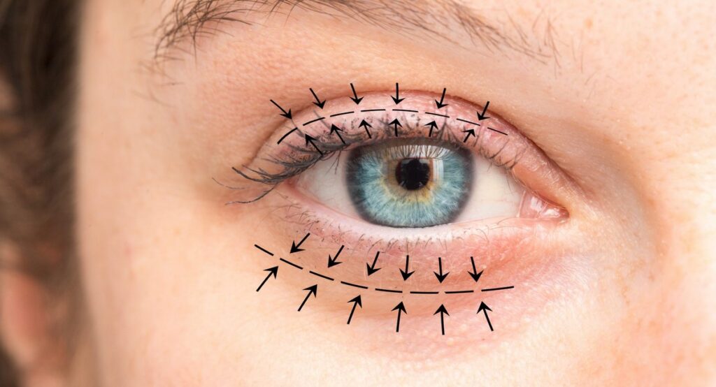 Oküloplasti Ameliyatı Nedir?