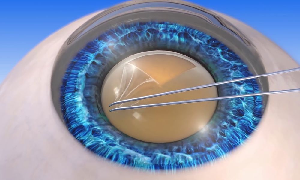 Katarakt Ameliyatı Ne Kadar Sürer