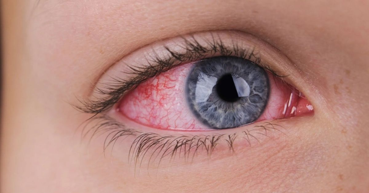 Göz Kuruluğu Belirtisi