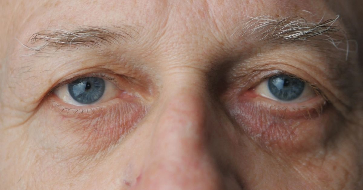 Yaşlılarda Göz Tansiyonu Belirtileri