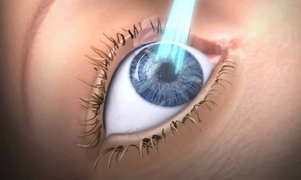 Lazer Göz Ameliyatı